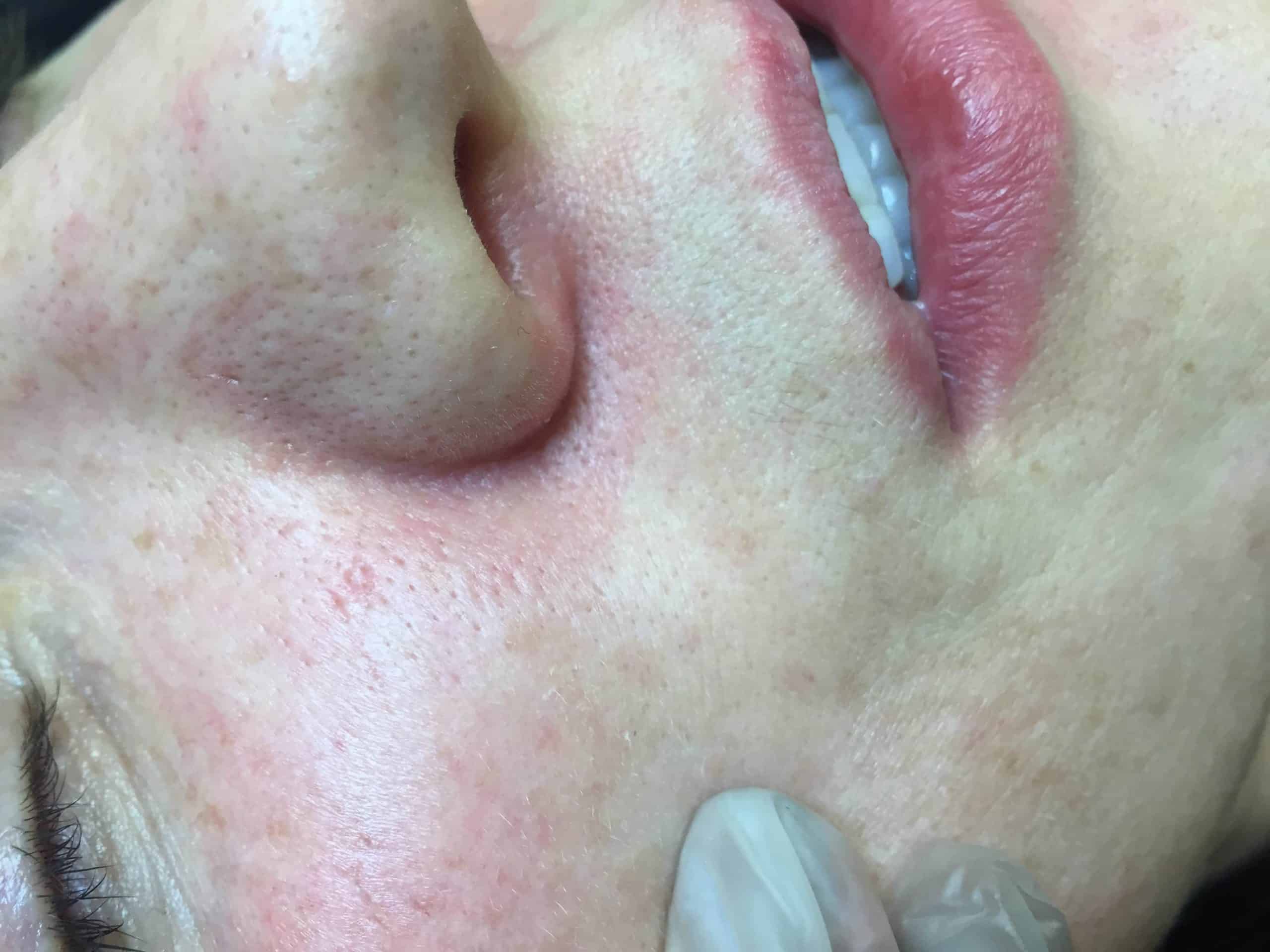 Broken Capillaries around the nostril AFTER